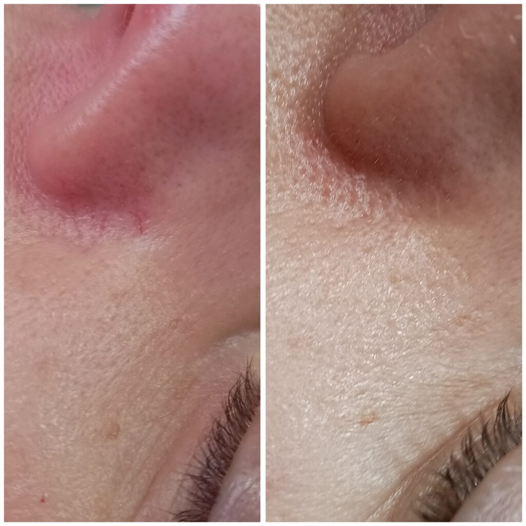 Zamykanie Naczynek  Znamion Rubinowych Bydgoszcz 04